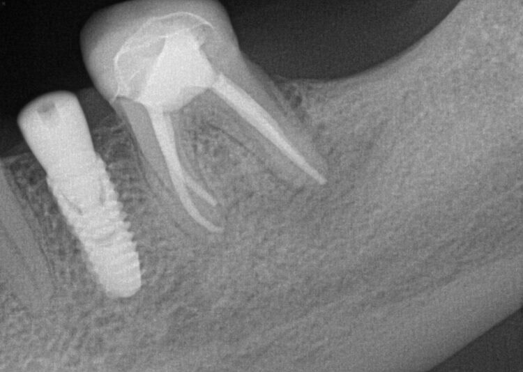 KB #20 Day of placement