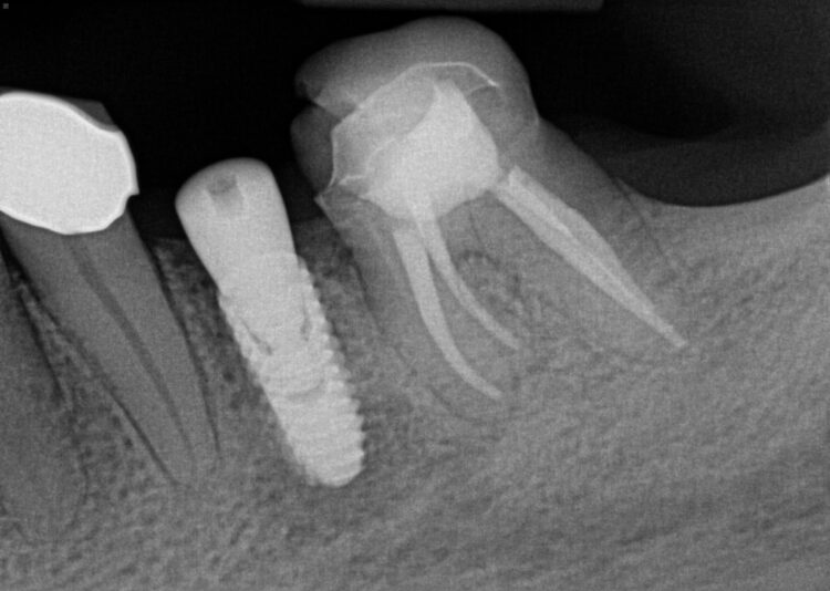 KB #20 9 months later