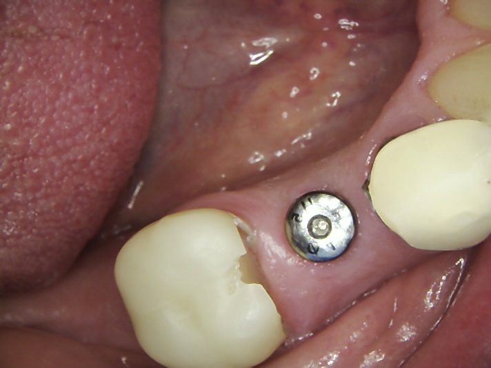 IO pic of soft tissue 9 months after placement