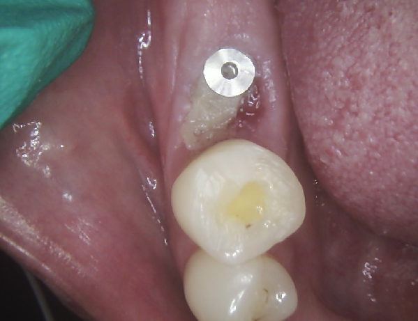 intraoral