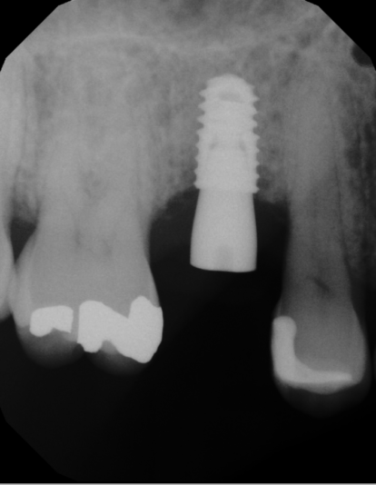 implant 4