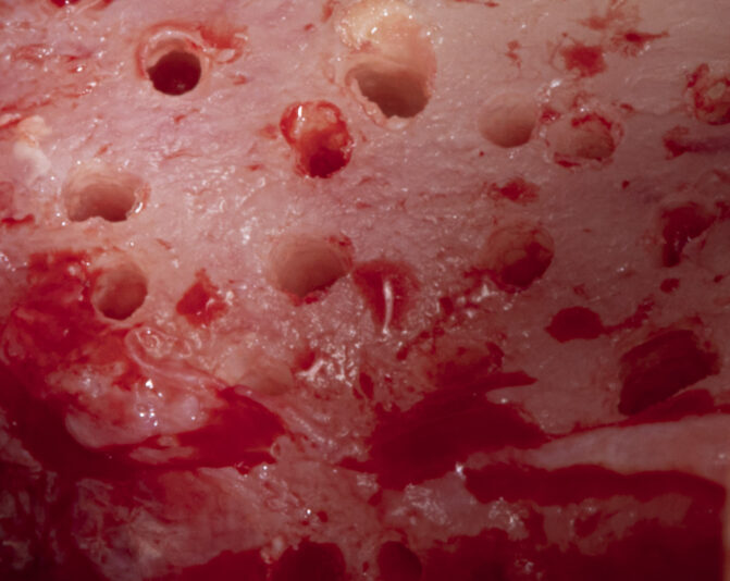 LOWER ANTERIOR SP AND GBR6_23