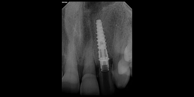 GROSS, MERLE 02_27_2024 Intraoral Periapical Image
