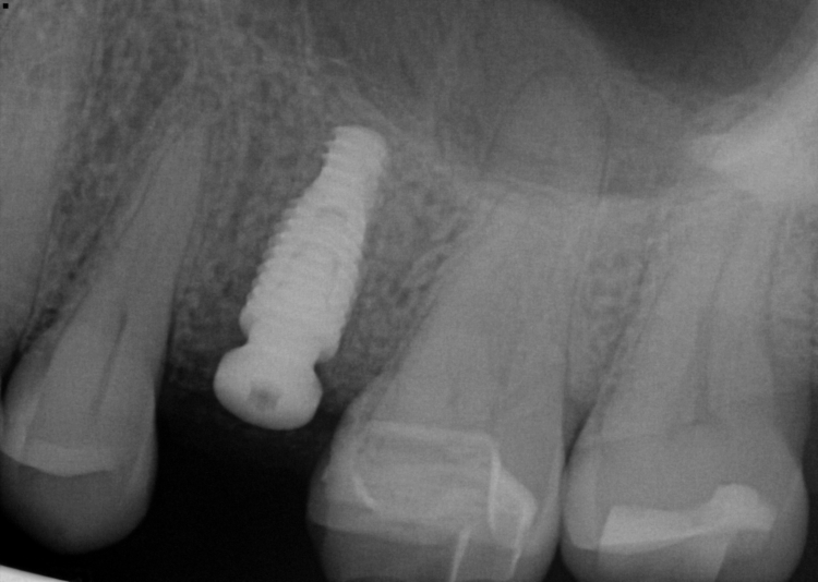 Implant 13