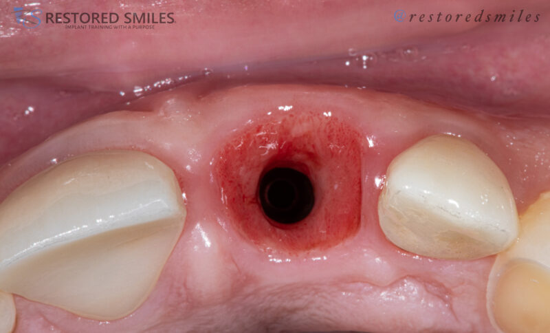 upper custom healing abutment
