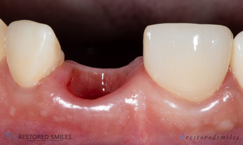 custom upper healing abutment2