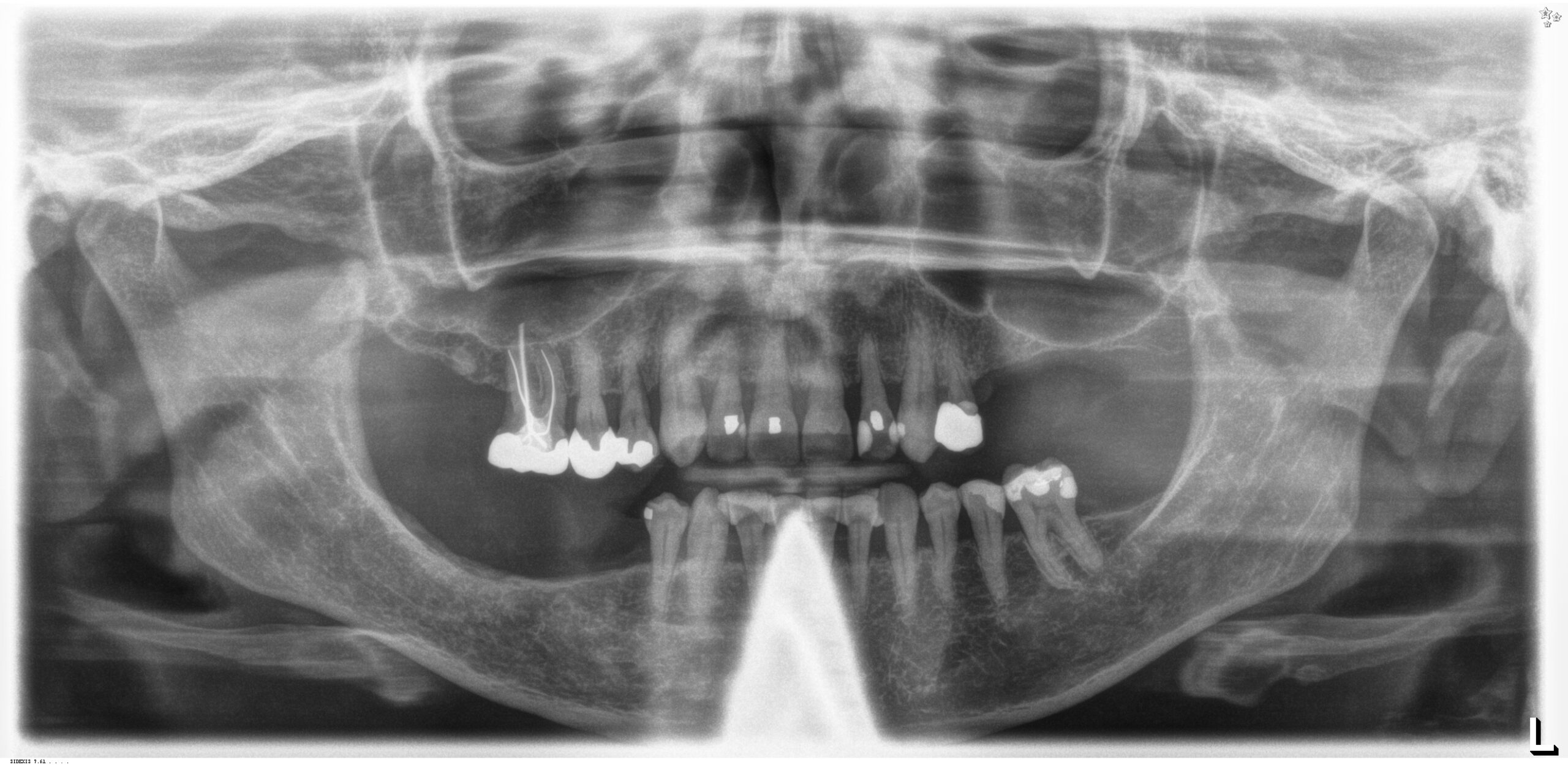 Implant Tx Planning